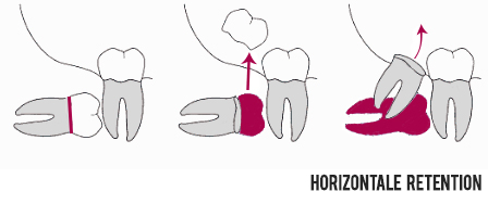 Osteotomie bei Weisheitszähnen Horizontal