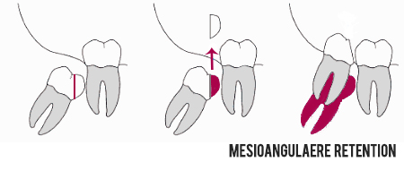 Osteotomie bei Weisheitszähnen Mesioangulär