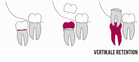 Osteotomie bei Weisheitszähnen Vertikal